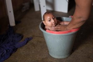 A baby with microcephaly born to a Brazilian mother infected with Zika.